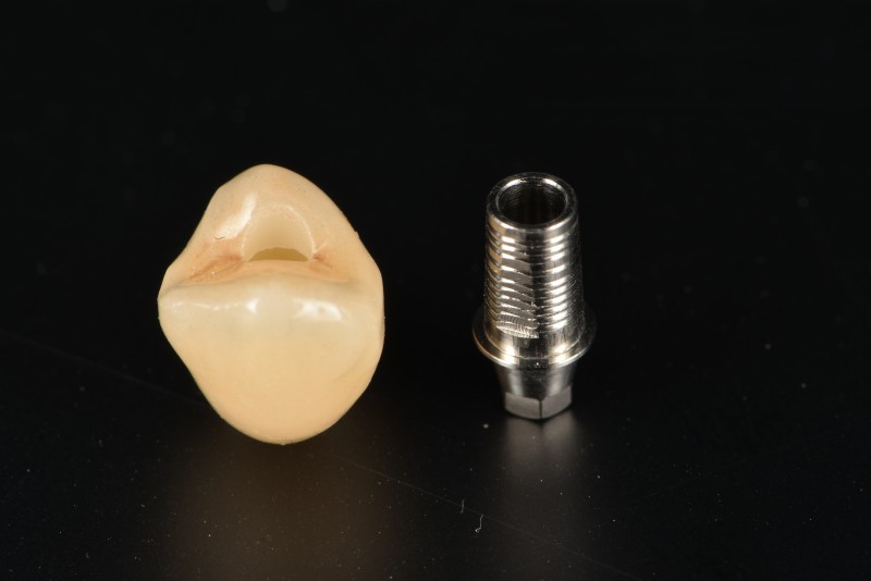 螺絲固定式牙冠/鈦基底