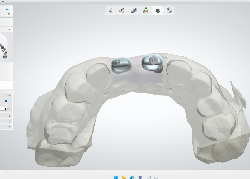 植體&Ti Bar 設計