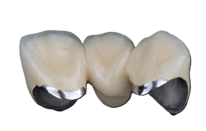 金屬燒附陶瓷冠