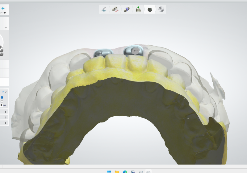 植體&Ti Bar 設計