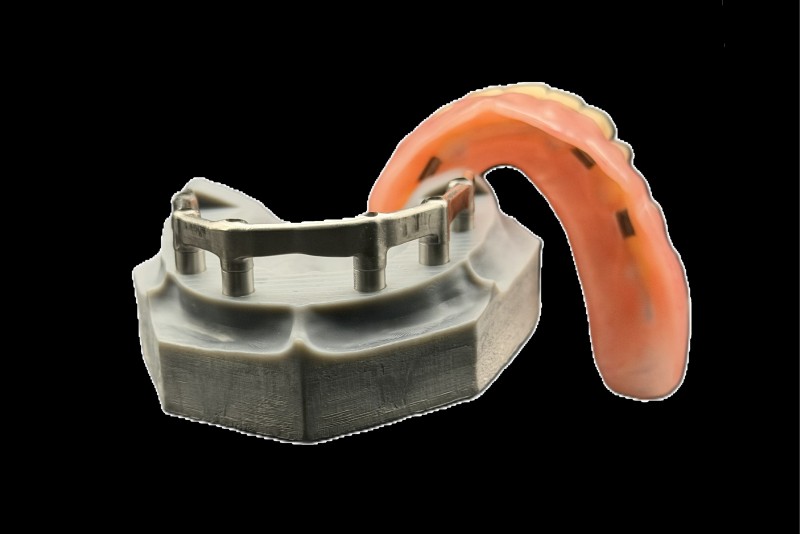 覆蓋式活動假牙-Hader Bar