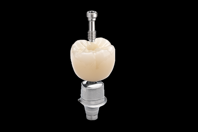 黏著式固定牙冠