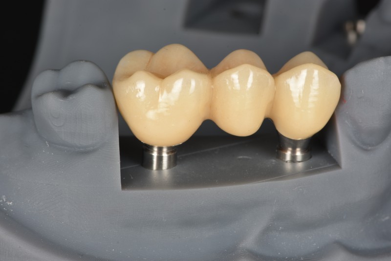 植牙一體冠橋