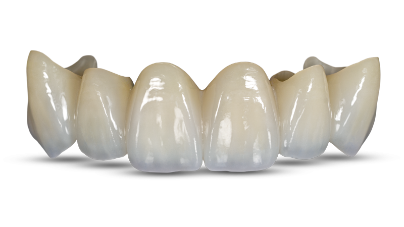 二氧化鋯燒附陶瓷冠