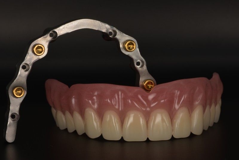 活動植牙贋復體